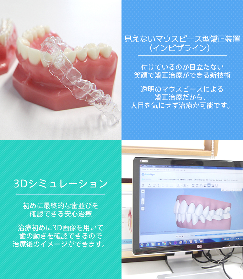 マウスピース型矯正装置（インビザライン）