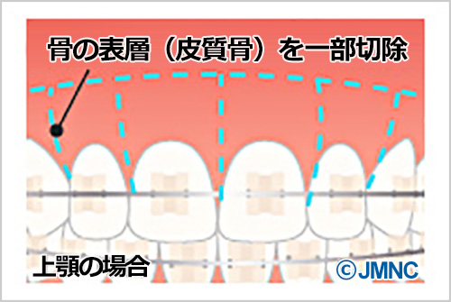 コルチコトミー